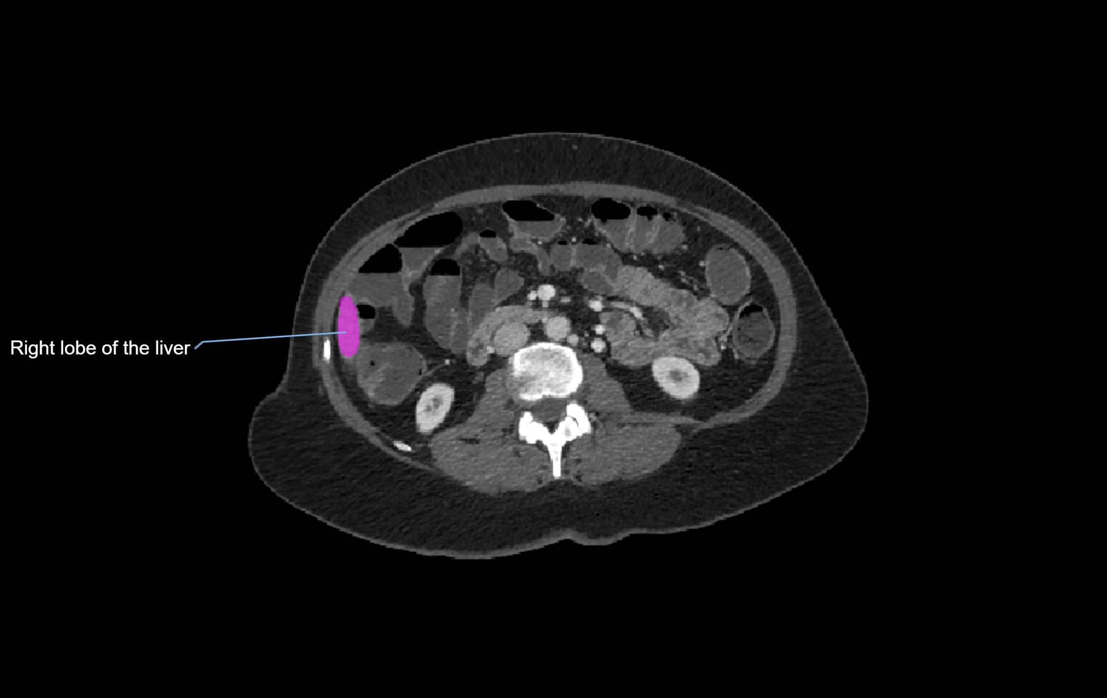 CT lliver lobes axial cross sectional anatomy labelled image -00004.webp